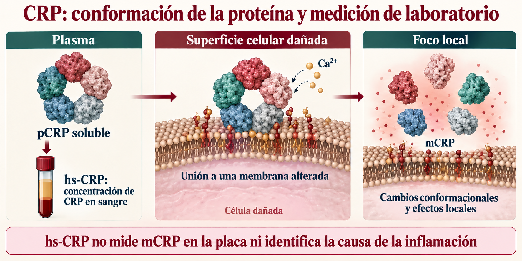 Pentámero soluble de CRP, unión a una membrana alterada y monómeros locales; hs-CRP mide la concentración sanguínea, no mCRP en la placa.